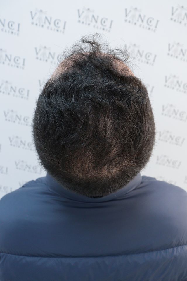 Antes do transplante de cabelo: vista de cima das entradas e coroa