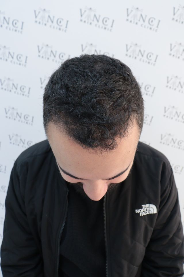 Antes do transplante de cabelo: vista de cima das entradas