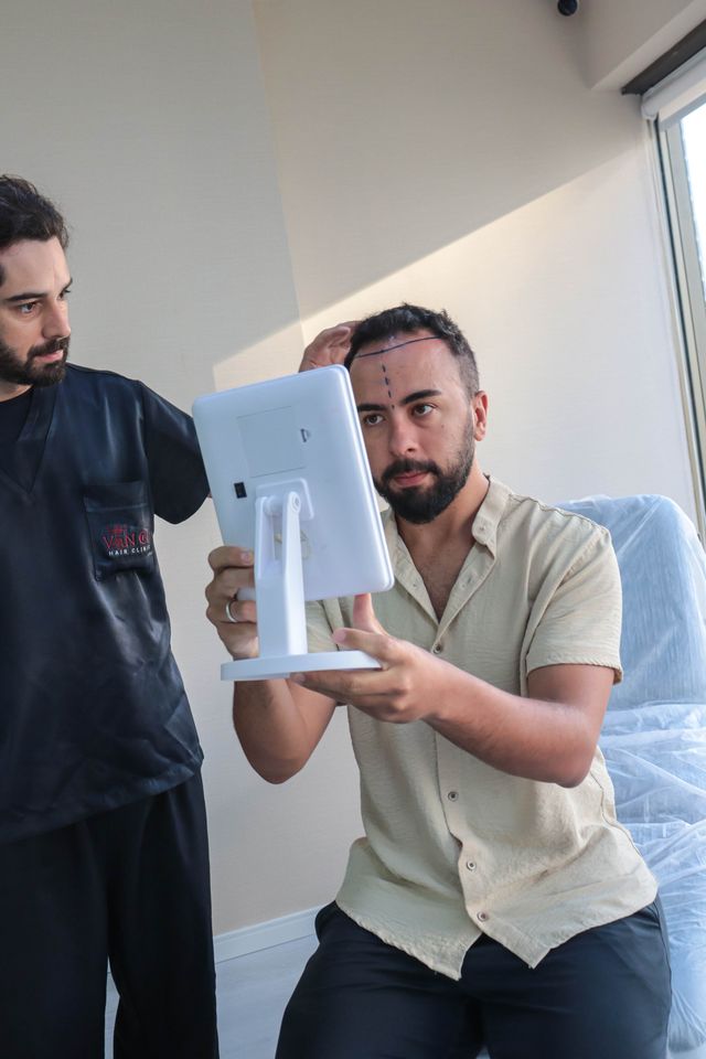 Desenho do transplante de cabelo: áreas que vão receber os fios