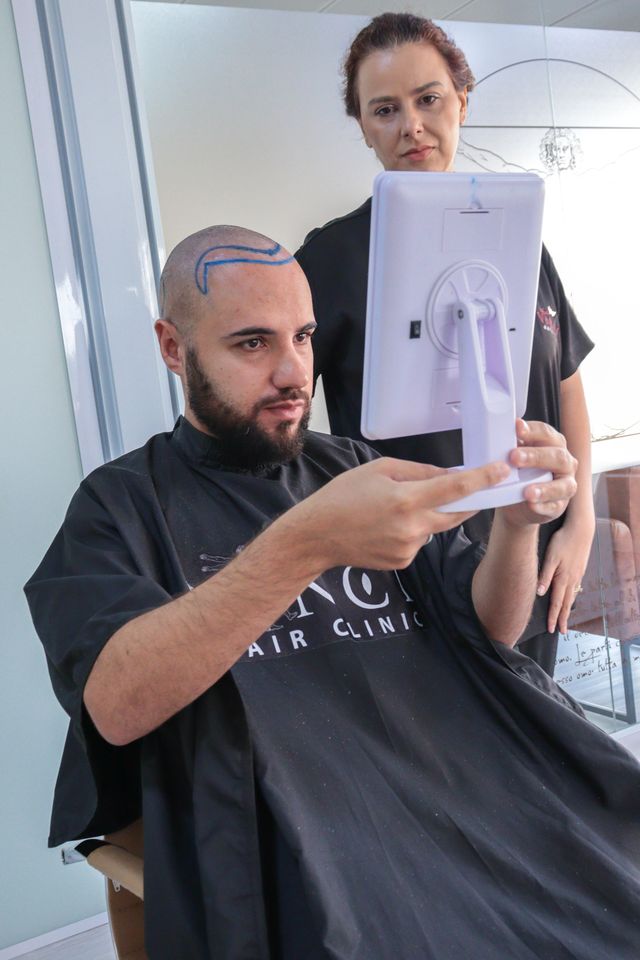 Desenho do transplante de cabelo: áreas que vão receber os fios