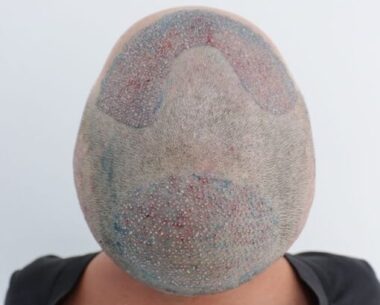 Pós Imediado do Transplante de Cabelo do Felipe nas entradas