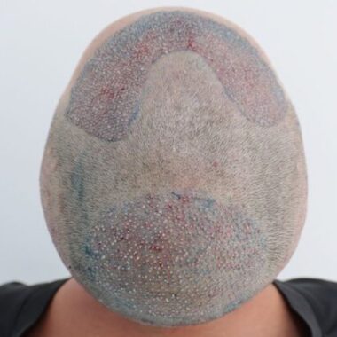 Pós Imediado do Transplante de Cabelo do Felipe nas entradas