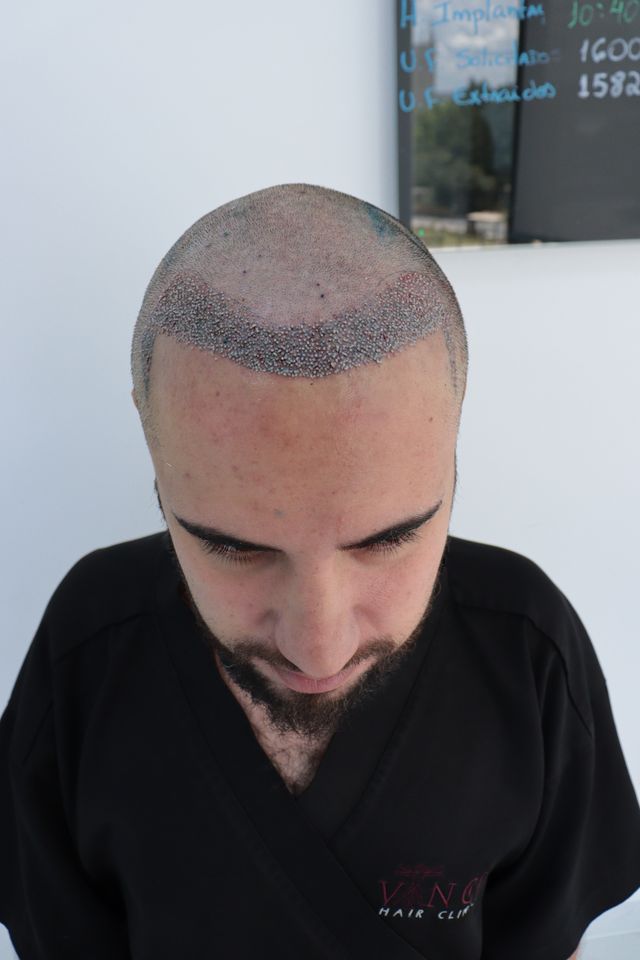 Pós Imediado do Transplante de Cabelo do Cassiano nas entradas