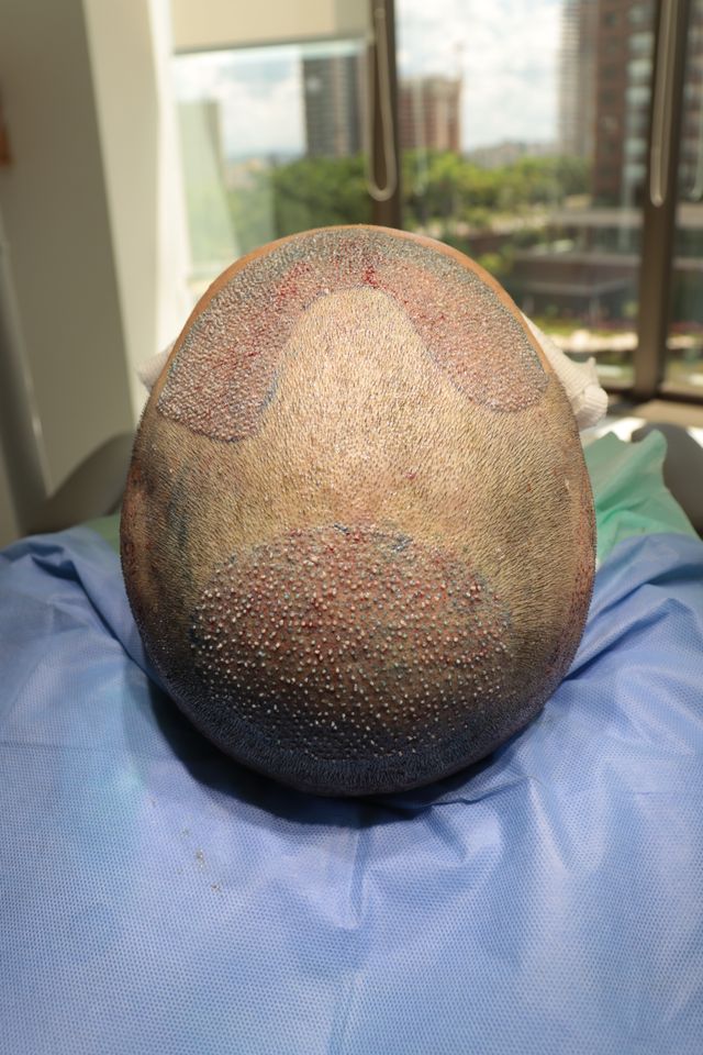 Transplante de Cabelo do Felipe após recebimento dos fios