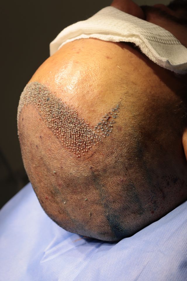 Transplante de Cabelo do Cassiano após recebimento dos fios